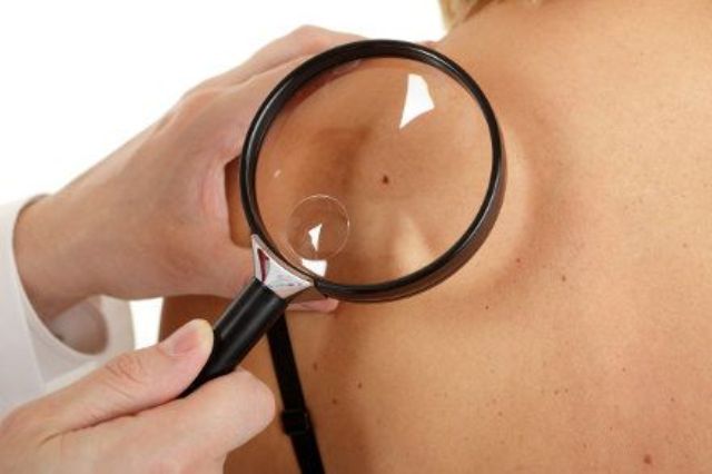 Melanoma, al via una campagna di informazione e prevenzione