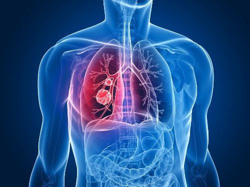 Tumori, per Agenas la rete oncologica toscana è al primo posto in Italia