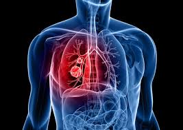 Cancro al polmone, Ispro in prima fila nella prevenzione
